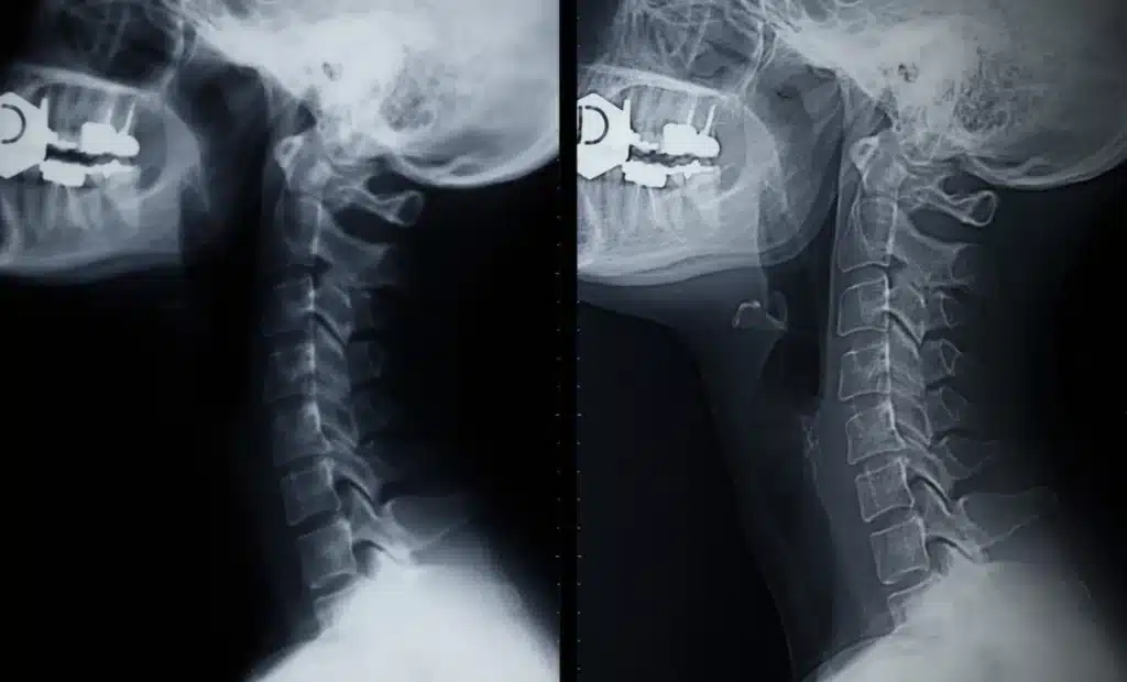 Examples of before and after spine surgery x-rays