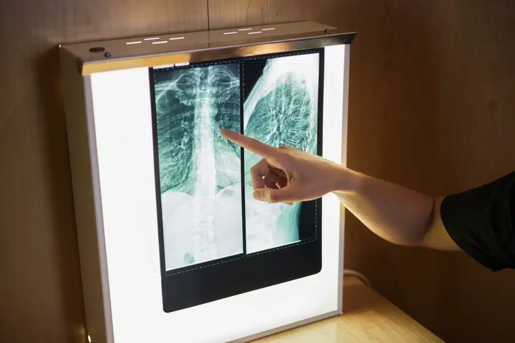 Doctor pointing to an x-ray picture