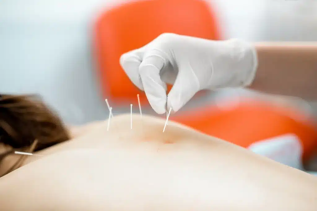 Acupuncturist hand putting needles in back
