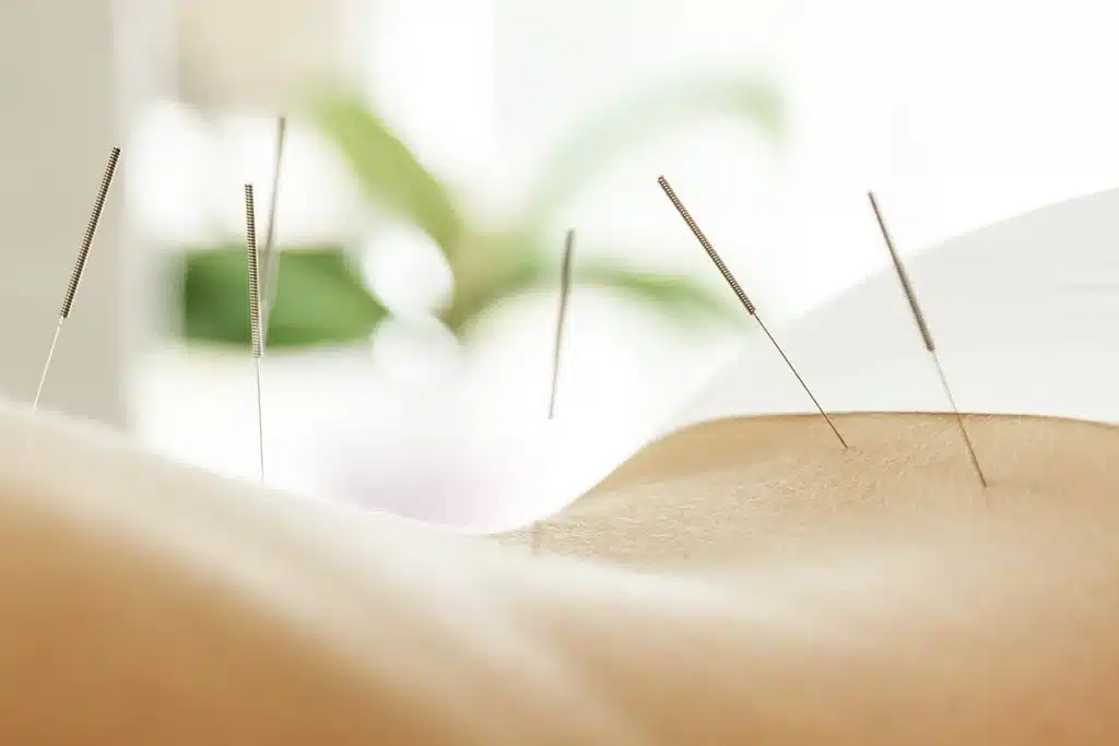 Female's patient back with acupuncture needles