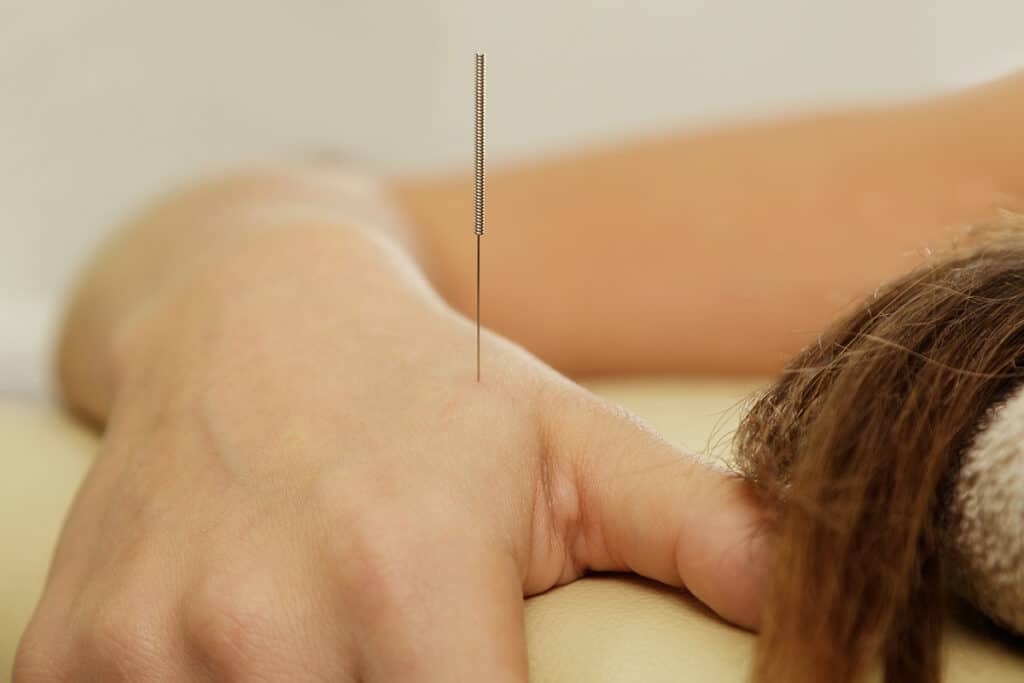 Female hand with steel needles during procedure of acupuncture therapy