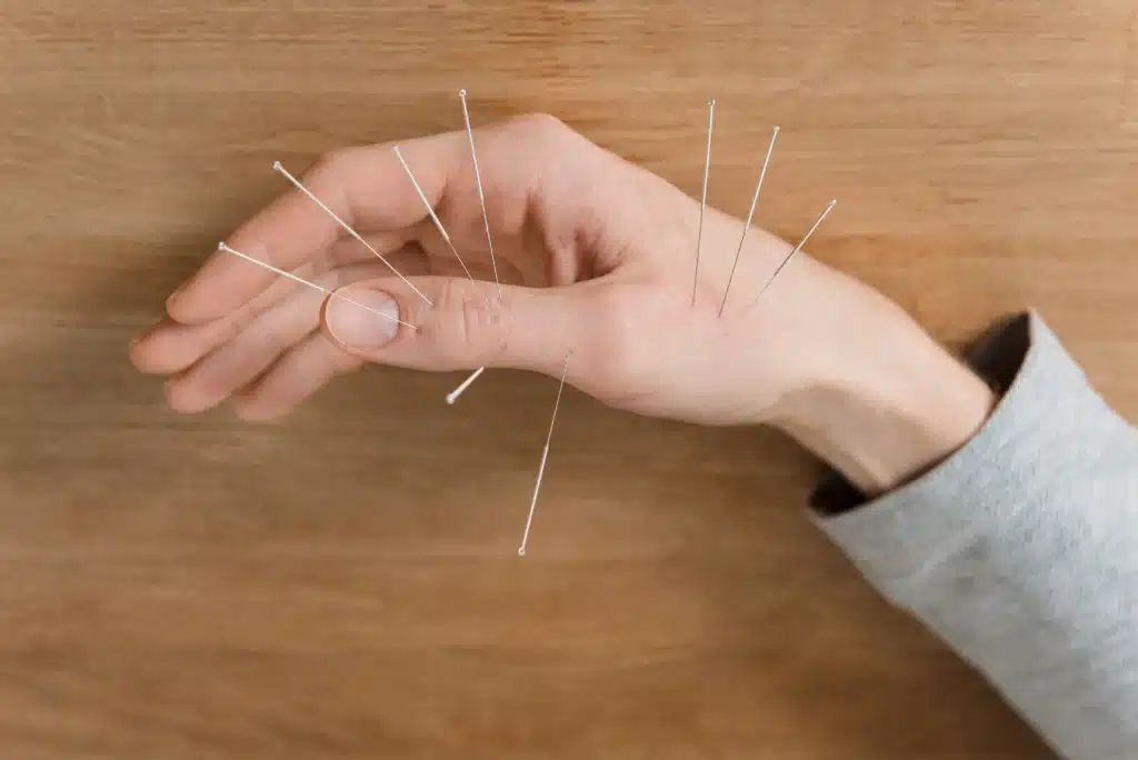 Hand with acupuncture needles for pain relief