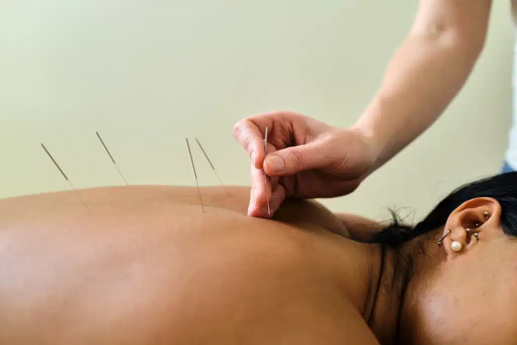 Acupunturist putting needles in woman's back