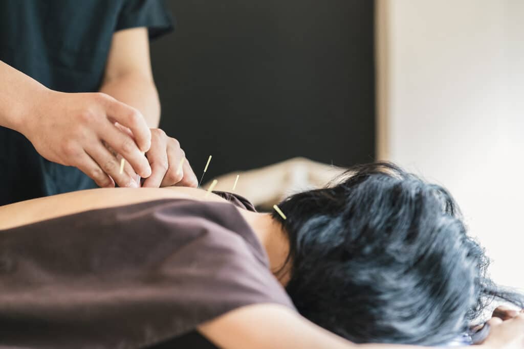 Therapist Giving acupuncture Treatment To Young Asian Woman