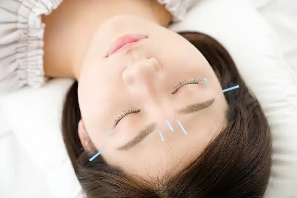 Woman receiving acupuncture treatment in face