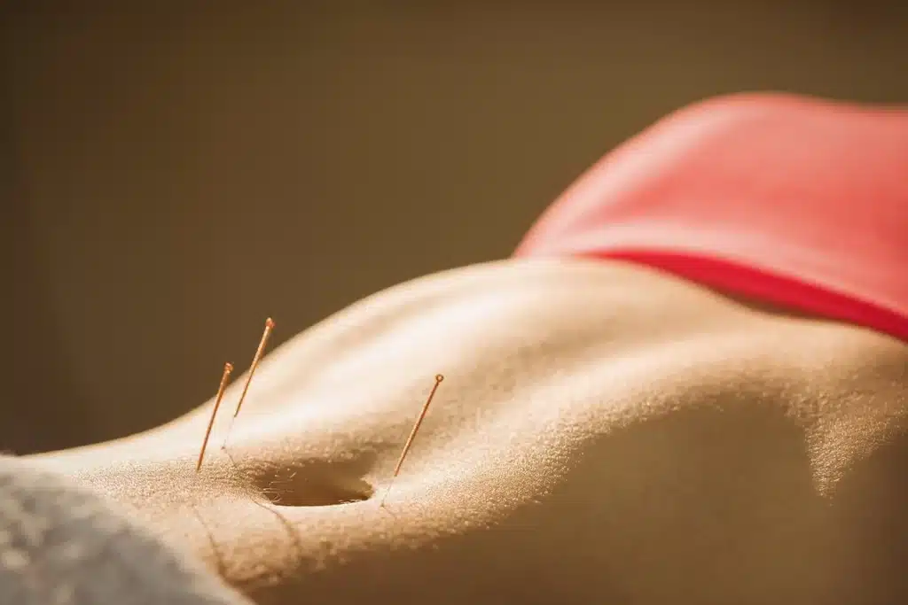 Young woman getting acupuncture in her abdomen