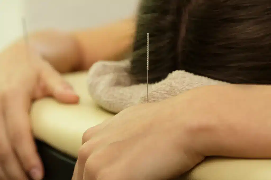 Female hand being treated with acupuncture