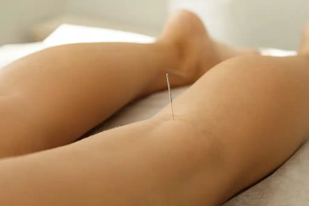 Woman leg with acupuncture needle