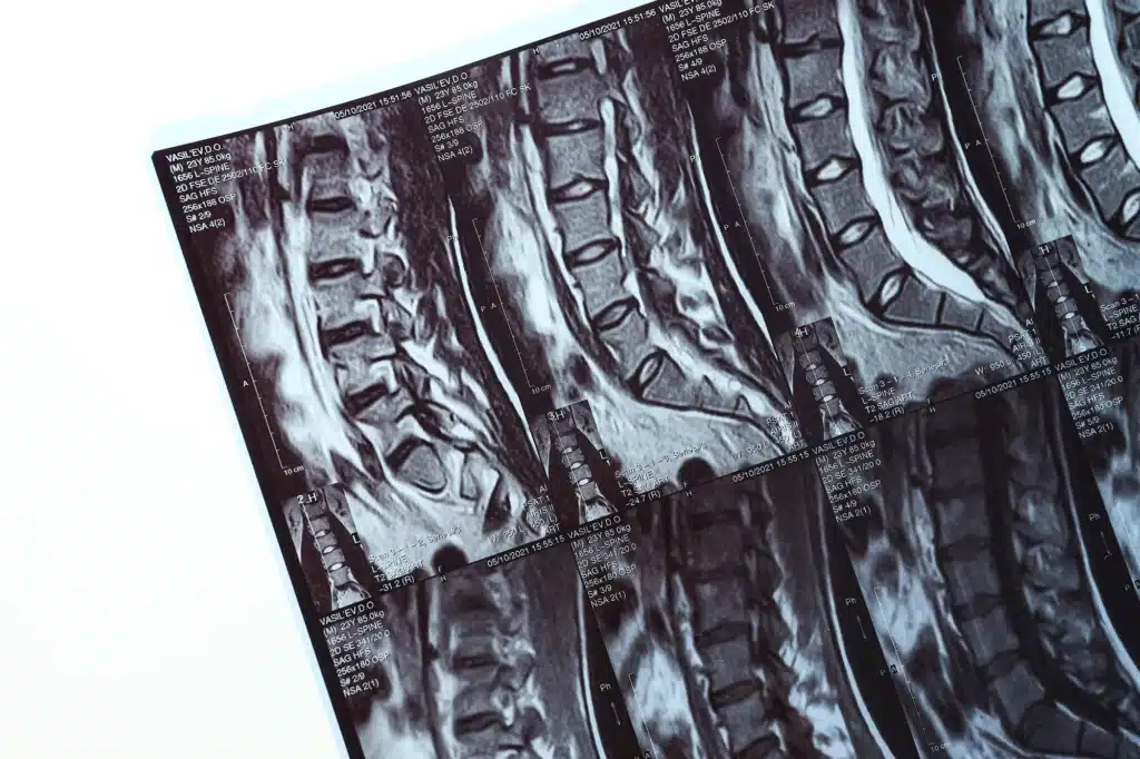 Close-up of an MRI scan showing detailed images of the human spine.