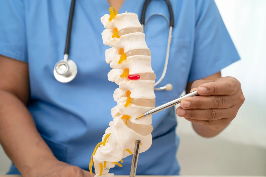 Doctor explaining spinal fusion protocol using a lumbar vertebrae model to demonstrate nerve alignment and surgical planning.