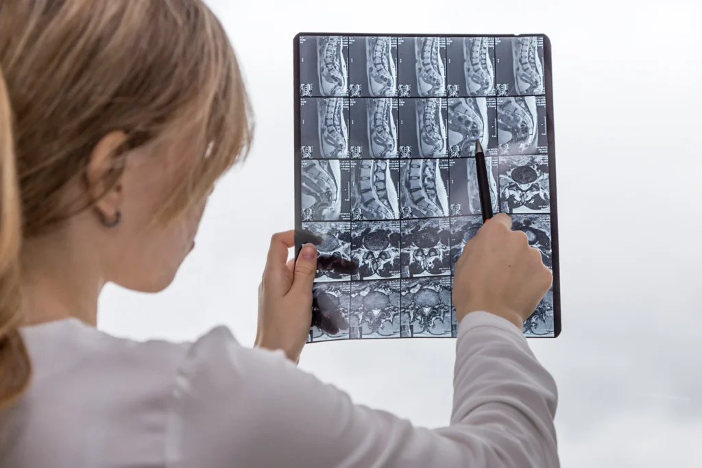 Doctor reviewing spinal MRI results for fusion surgery ICD-10 coding