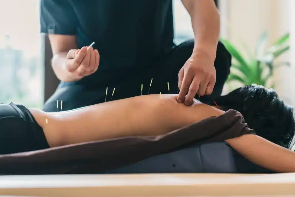 Therapist performing acupuncture physical therapy on a patien