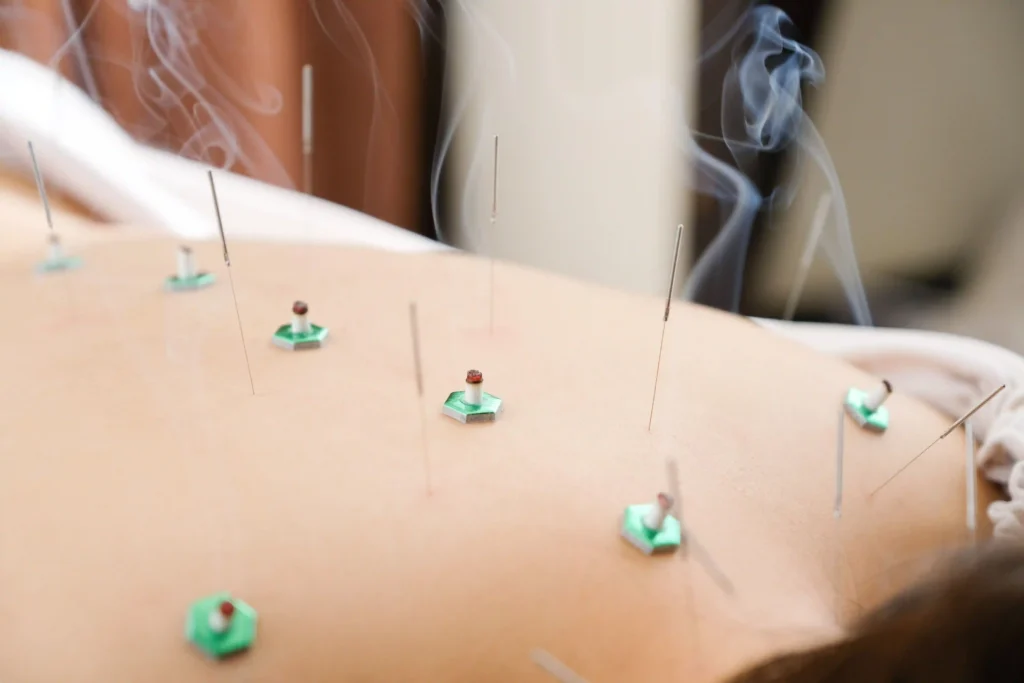 Acupuncture physical therapy session with needles and moxibustion on a patient's back, promoting pain relief and relaxation.