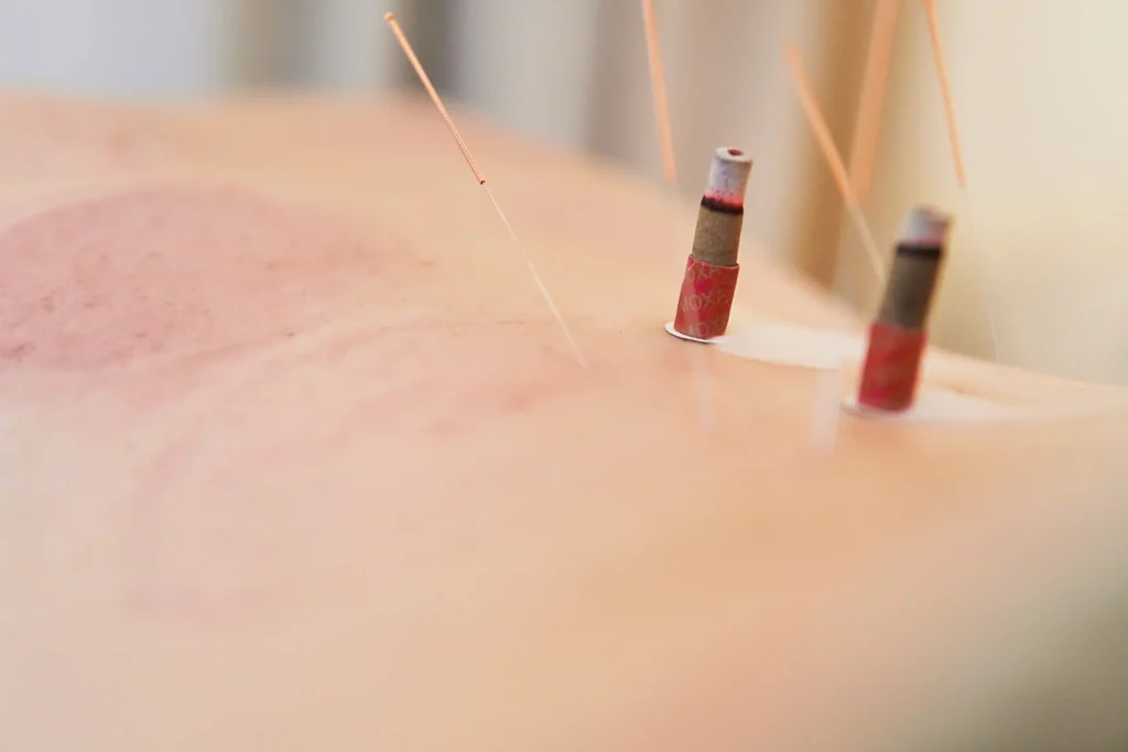 Close-up of acupuncture physical therapy with needles and moxibustion used for improved healing and reduced inflammation.