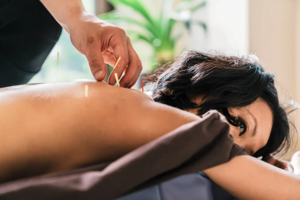 A therapist administering acupuncture physical therapy to a patient, targeting trigger points for muscle relaxation and pain relief.